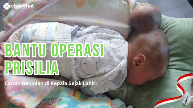 Bantu Prisilia, Bayi Mungil yang Menahan Sakit di Kepala Sejak Lahir